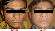 Face Surgery Cost in India