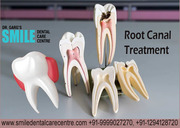 Dental Clinic For Painless Root Canal Treatment