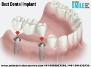 Best Dental Implant in Faridabad Clinics In India