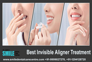 Best Invisible Aligner Treatment – Clear Aligners in Faridabad