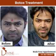 Botox Treatment in Delhi Gurgaon