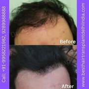 Best Hair Transplant Delhi