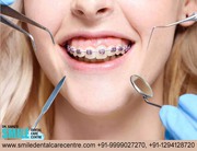 Dental Braces Treatment in Faridabad India At Smile Dental Care Centre