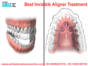 Clinic For Best Invisible Aligner Treatment in Faridabad