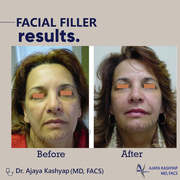 Facial Filler Treatment