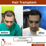 Is Hair Transplant Treatment Expensive? 