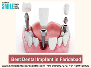 Dental Implants Treatment - Dental Implant Clinic in Faridabad