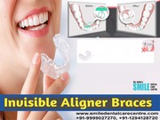 Best Invisible Aligner Treatment Orthodontic Treatments