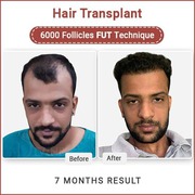 HAIR TRANSPLANT CLINIC,  SURGEON IN DELHI