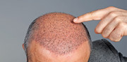 Hair Transplant Cost in Delhi