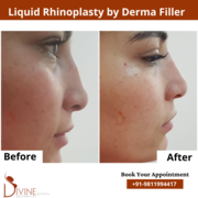  Rhinoplasty in Delhi – Nose Plastic Surgery in Delhi