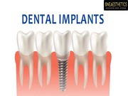 Consult Dental Implants Clinic in Gurgaon	