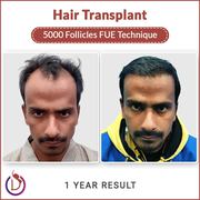  Long Hair Transplant in India - Dr. Amit Gupta