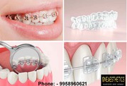 What Are the Different Types of Dental Braces Treatment in Gurgaon Off