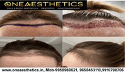 Consult Best Hair Transplant Surgeon in Delhi and Gurgaon